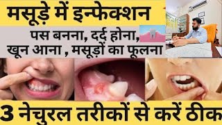 मसूड़ों की सूजन और इंफैक्शन को करे जड़ से खत्म | Eliminate Gum Swelling And Infection From Its Roots