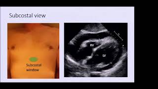 Focused cardiac ultrasound: Evolving teaching with technology