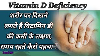 Vitamin D Deficiency/शरीर पर दिखने लगते हैं विटामिन डी की कमी के लक्षण, जानिए समय रहते कैसे पहचानें