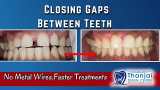 Closing Teeth Gap with Invisalign |Faster Treatments without  Metal Braces