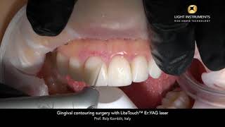 Gingival contouring surgery with LiteTouch™ Er:YAG laser