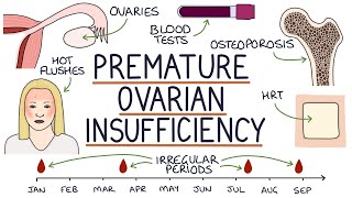 Understanding Early Menopause: Premature Ovarian Insufficiency