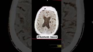 Brain of alcoholic person #radiology #ct