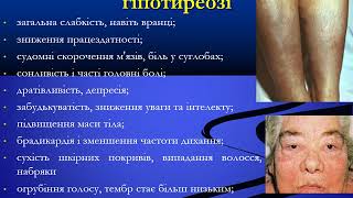 Захворювання щитоподібної та прищитоподібних залоз. ФТЕТ