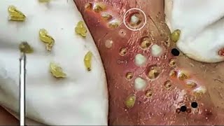 acne tv #048 | Milia, Cystic Acne, Nice pimples & Blackheads Extraction