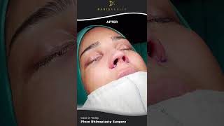 Piezo Rhinoplastyb Surgery  #turkeyhealthtourism #germany #rhinoplasty_nose_surgery