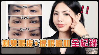 「割雙眼皮＋提眼瞼肌＋開眼頭手術」超驚豔✨我的無神內雙變電眼｜ 雙眼皮推薦陳彥瑋醫師  #雙眼皮