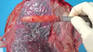 Fresh Placenta Membranes Dissection Tutorial - for medical professionals