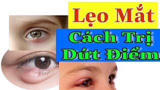 Lẹo Mắt Ảnh Hưởng Thế Nào Trong Sinh Hoạt, Những Cách làm Dứt Điểm Lẹo Mắt