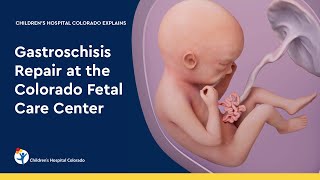 Gastroschisis Repair at the Colorado Fetal Care Center