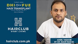 Hybrid FUE Hair Transplant with DHI Technology by Hair Club Associates.