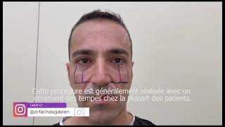 Chirurgie Du Lifting Moyen Du Visage