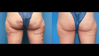 Aveli Cellulite Reduction