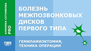 Болезнь межпозвонковых дисков 1 го типа. Гемиламинэктомия. Техника операции