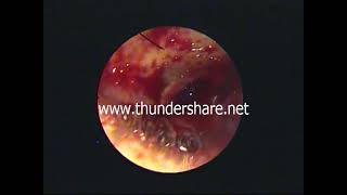 Endo tplasty ,posterior canal flap and vascular strip-dr.shreekantha acharya