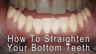 Dental Braces - How to Straighten your bottom front teeth