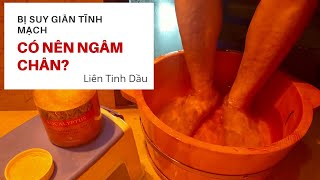 Bị suy giãn tĩnh mạch có nên ngâm chân hay không?