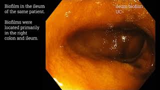 Examples of endoscopically visible gastrointestinal biofilms