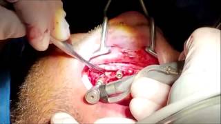 Implant Surgery - Hoffman Dental