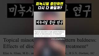 탈모치료제 미녹시딜, 중단하면 이렇게 됩니다.. (1년 중단 실험)