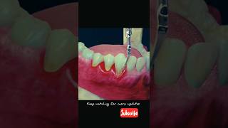 Dentistry! Scaling process#dentist#dental#trending#new#music#song#viralvideo#explore#vlog#fun#edit