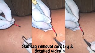 Skin tag removal by cautery || Procedural & detailed video in hindi || How to get rid of skin tags