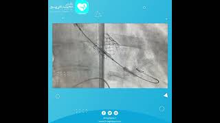 تعویض دریچه آئورت به روش غیر جراحی