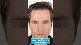 100% natürliche Haartransplantation