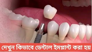 দেখুন কিভাবে ডেন্টাল ইমপ্লান্ট করা হয় খরচ ৫০-৬০ হাজার টাকা। নতুন দাঁত লাগানোর পদ্ধতি। Tech Dental