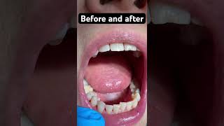 The before and after #shorts #viral #youtube #explorepage #teeth #smile #foryou #videooftheday