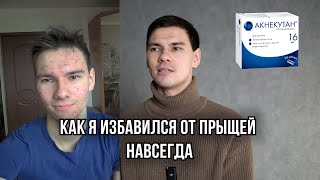 Как я избавился от прыщей