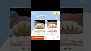 Before and after perawatan di xxone dental care #shorts Dokter Gigi Kota Metro Lampung