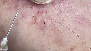 Big Cystic Acne Blackheads Extraction Blackheads & Milia, Whiteheads Removal Pimple Popping