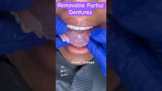 Removable Partial Dentures