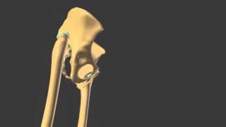 Hip dysplasia dislocation complete neoacetabulum