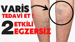 Bacak Ağrısı nedenleri ? BACAK AĞRILARINI HAFİFE ALMA (varis için etkili ve kolay 2 egzersiz)