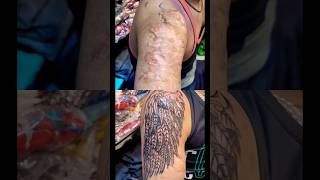 burning mark remove tattoo #tattoo