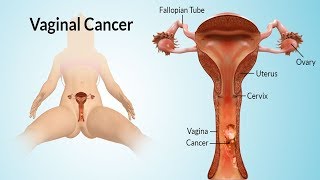 Precancerous Cells on Cervix - What happen If they're Left Untreated