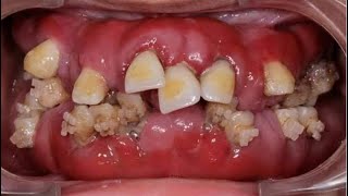 OMG!! Yuck mouth!! Top 25 Gross Dental Pictures of rotten teeth!