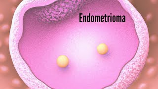 Bilateral endometrioma of the ovaries, ultrasound and color Doppler video