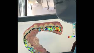 Utilizando o escaneamento bucal em 3 D  para planejar tratamento para bruxismo e mordida  cruzada