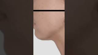 Check out the jawlines we are achieving with energy instead of scalpels!