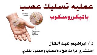 عمليه تسليك عصب بالميكرروسكوب الجراحى الدكتور ابراهيم عبد العال