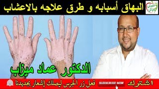 البهاق أسبابه و طرق علاجه بالاعشاب مع الدكتور عماد ميزاب