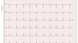 Basic of ecg part 1 #ecg