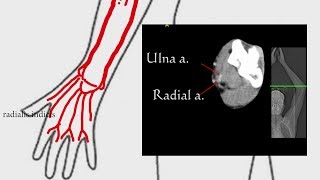 Upper Limb Anatomy & CT Anatomy