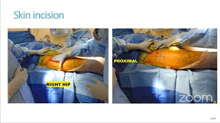 Step-by-Step Approach to Direct Anterior Hip Replacement