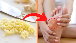 Natural Tips and Home Remedies For Athlete's Feet | Health Tips