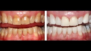 Blanquea tus Dientes en solo 3 minutos! Remedio casero facil!