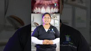 ஈறு கருப்பு நிறத்தில் உள்ளதா? Dark patches on gums | Dr. Aparna | Dental Kings